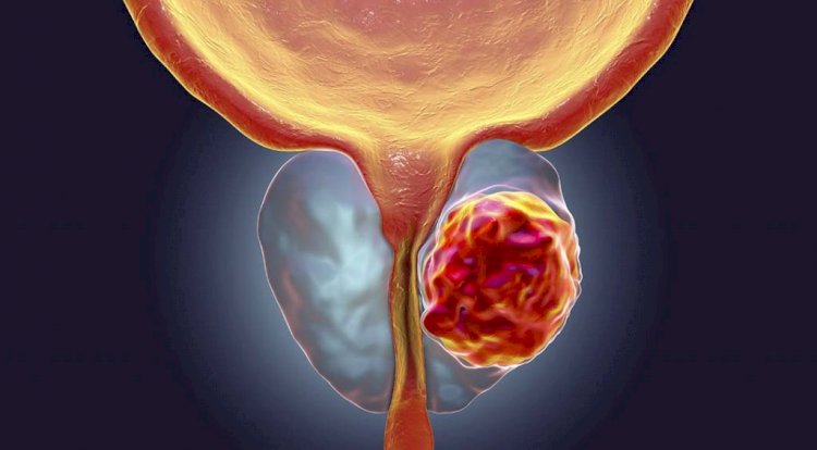 Espírito Santo deve registrar mais de 1.700 casos de câncer de próstata em 2023
