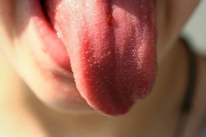Colunistas  Coluna Dr. Guilherme Laporti: Câncer de língua: quando suspeitar e como prevenir